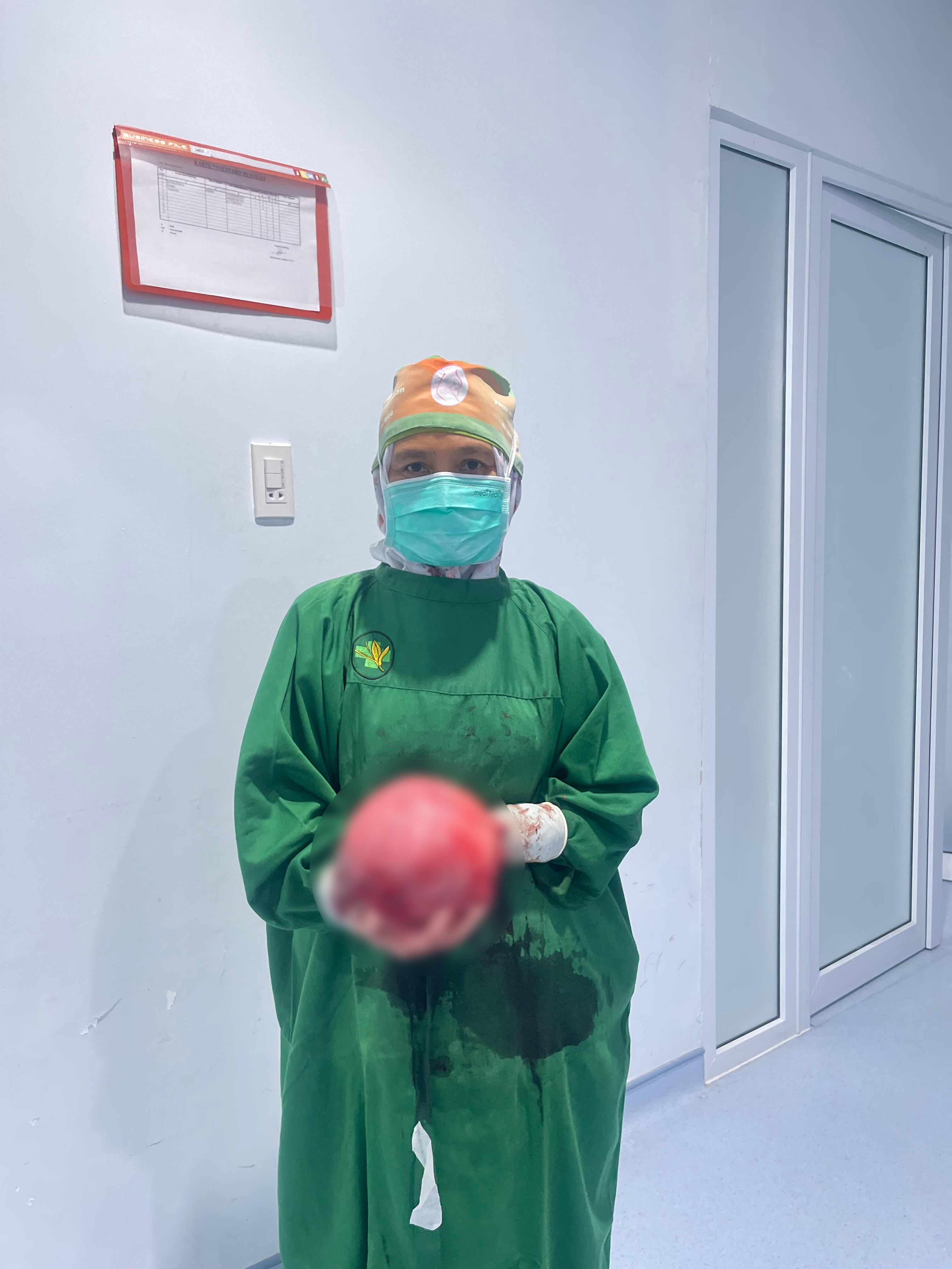 dr. Nova Roslita, Sp.OG dan tim RSU Jeumpa Hospital berhasil mengangkat tumor berukuran 30 cm seberat 2 kg